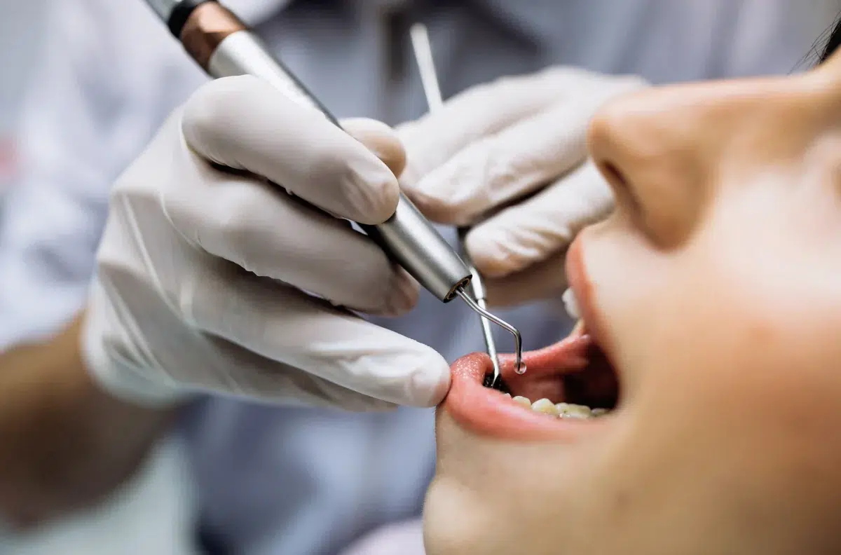 tratamiento de caries con resina en querétaro